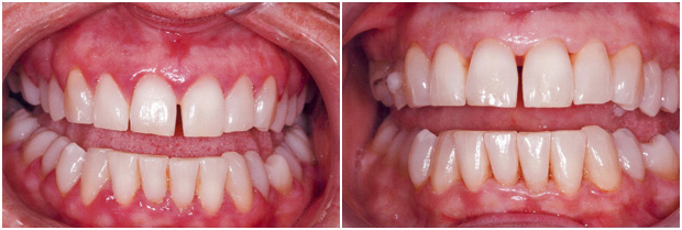 before-after-gum-surgery