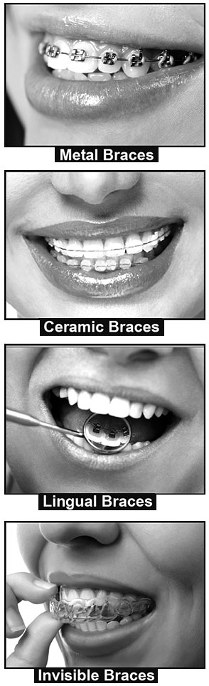 braces-dental