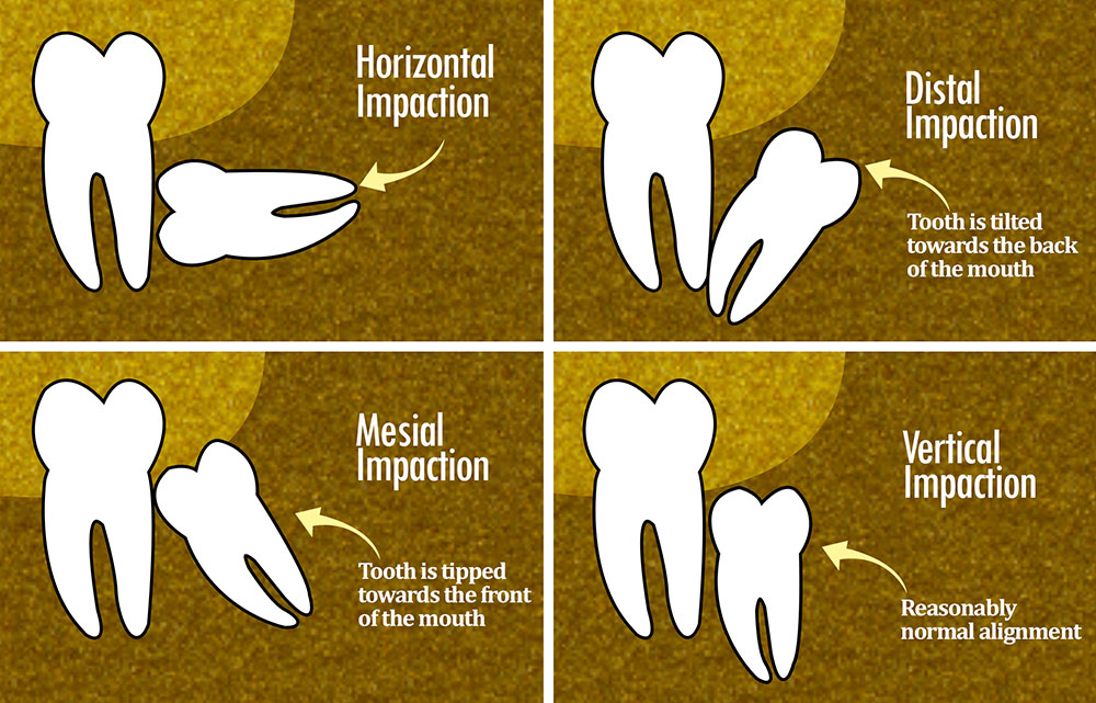 Dental-impaction-types