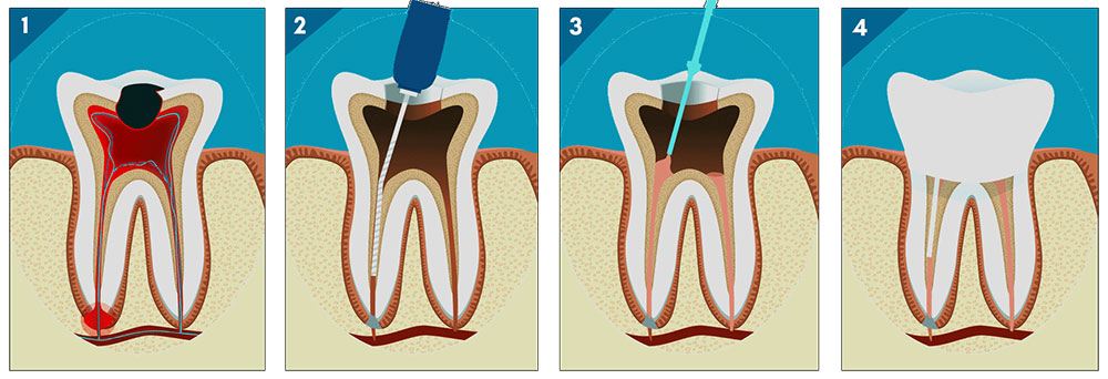 root-canal- procedure