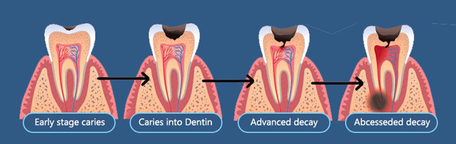 Dental-Caries-Progression