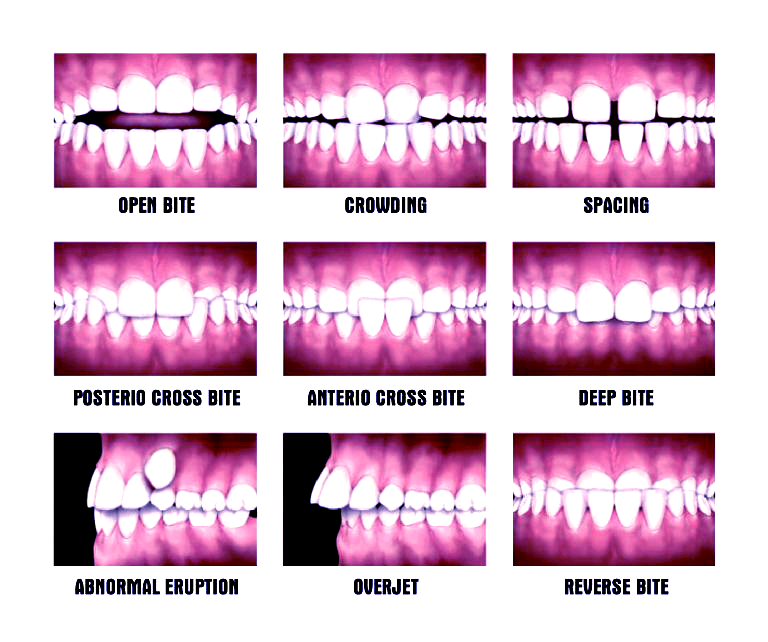 malocclusion-types